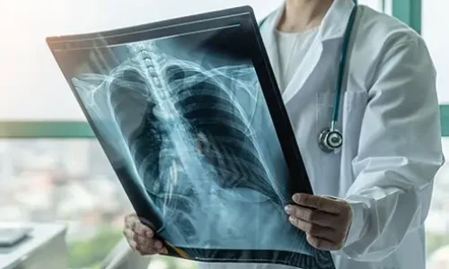 what-are-the-4-stages-of-copd